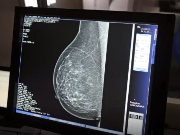 C&acirc;ncer de mama: uma em cada tr&ecirc;s pacientes tem menos de 50 anos